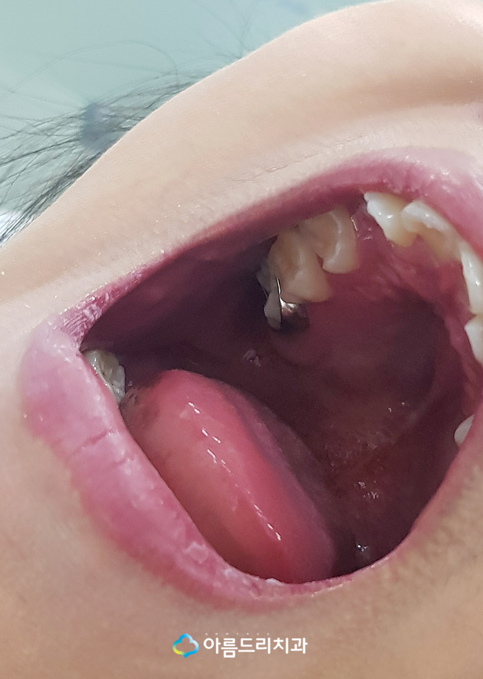 어린이치아교정 부정교합 RPE(급속구개확장장치) 악궁확장장치 관련 이미지 8