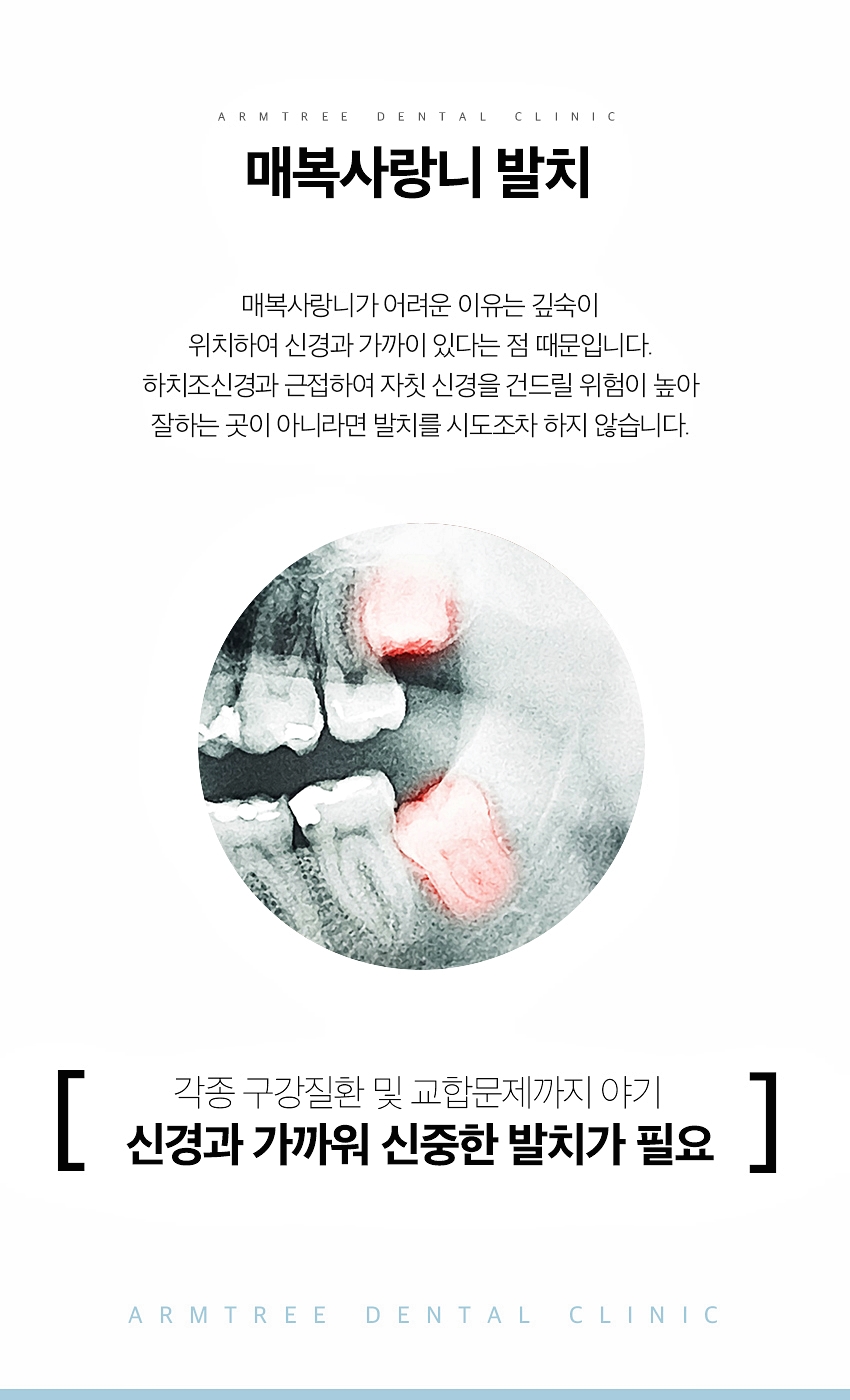 매복사랑니발치 통증없는 아름드리치과 관련 이미지 3