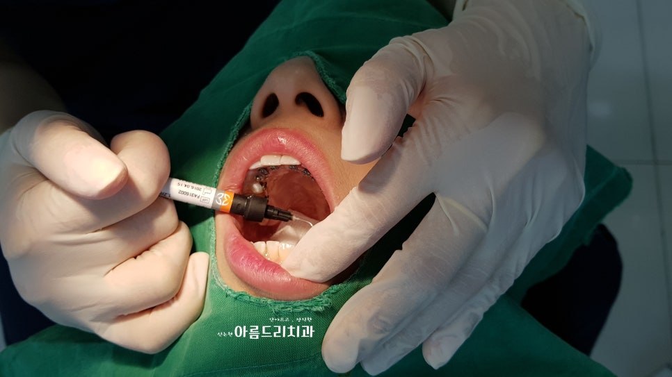설측교정_신논현역 치과_야간진료 관련 이미지 3