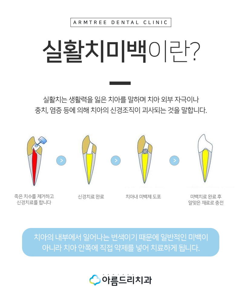 실활치미백 앞니 색깔 신경치료 치아변색 후기 관련 이미지 4