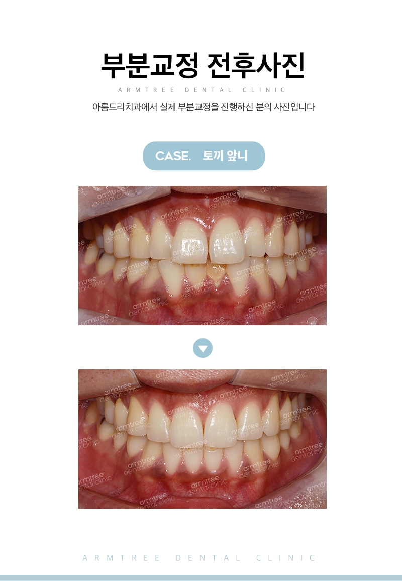 입툭튀교정 돌출앞니부분교정 후기는 아름드리치과 관련 이미지 11