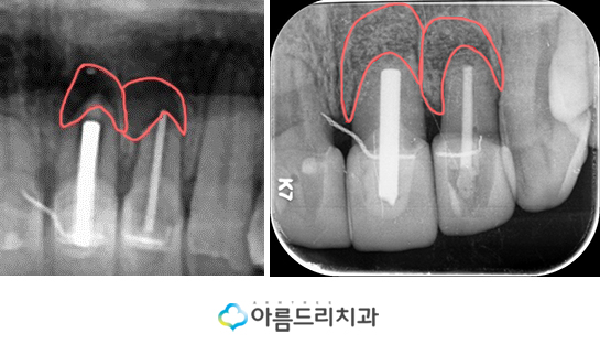 치근단절제술 후기로보는 완벽함 관련 이미지 9