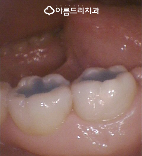 충치인레이 아말감주변 충치치료는? 관련 이미지 8