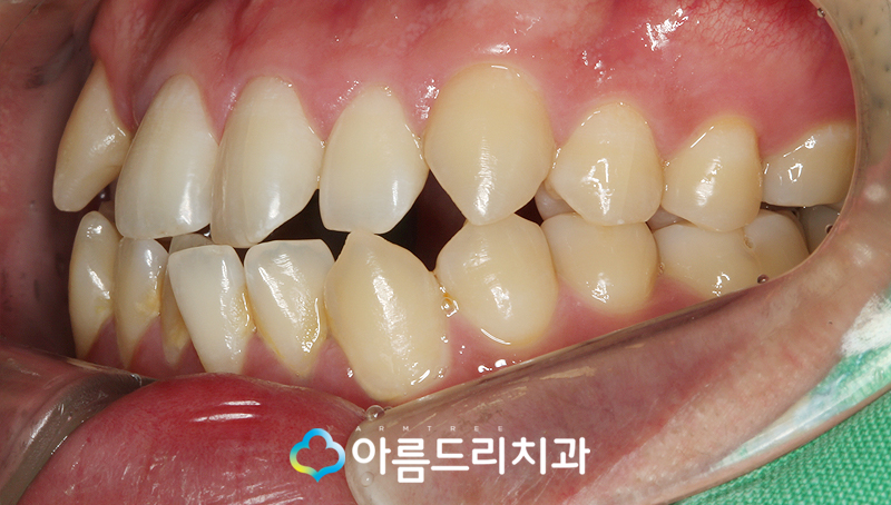 투명교정장치 인비절라인 치과 후기 관련 이미지 4