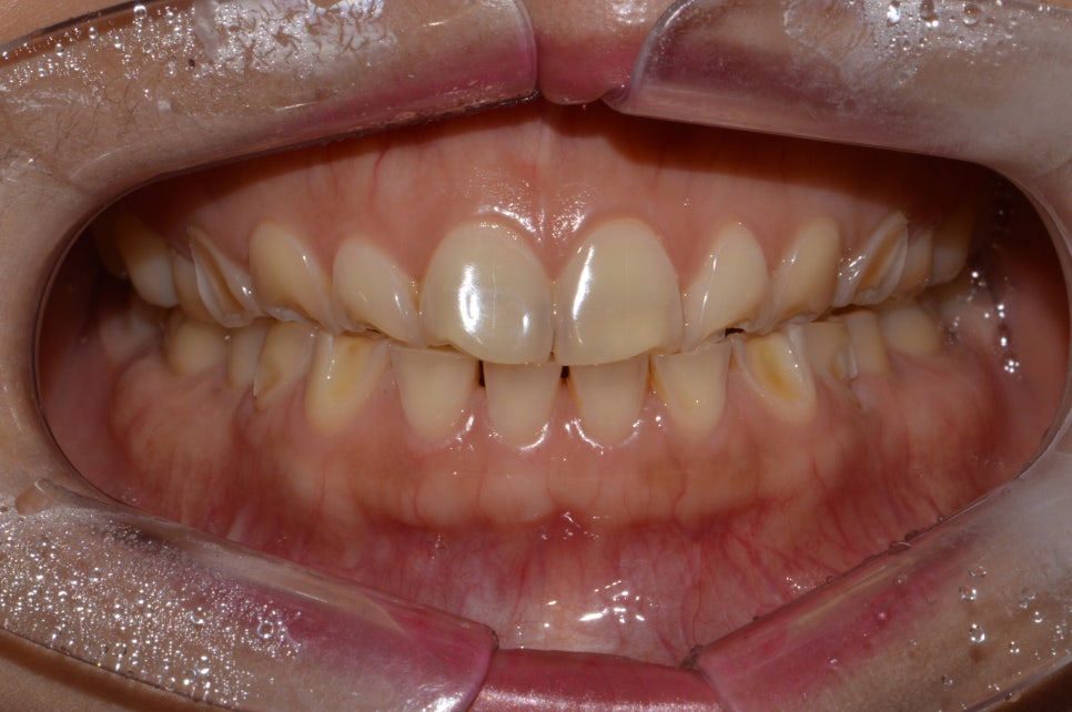 [신논현 치과] 3D 구강 스캐너_정확하게 본뜨기 관련 이미지 10