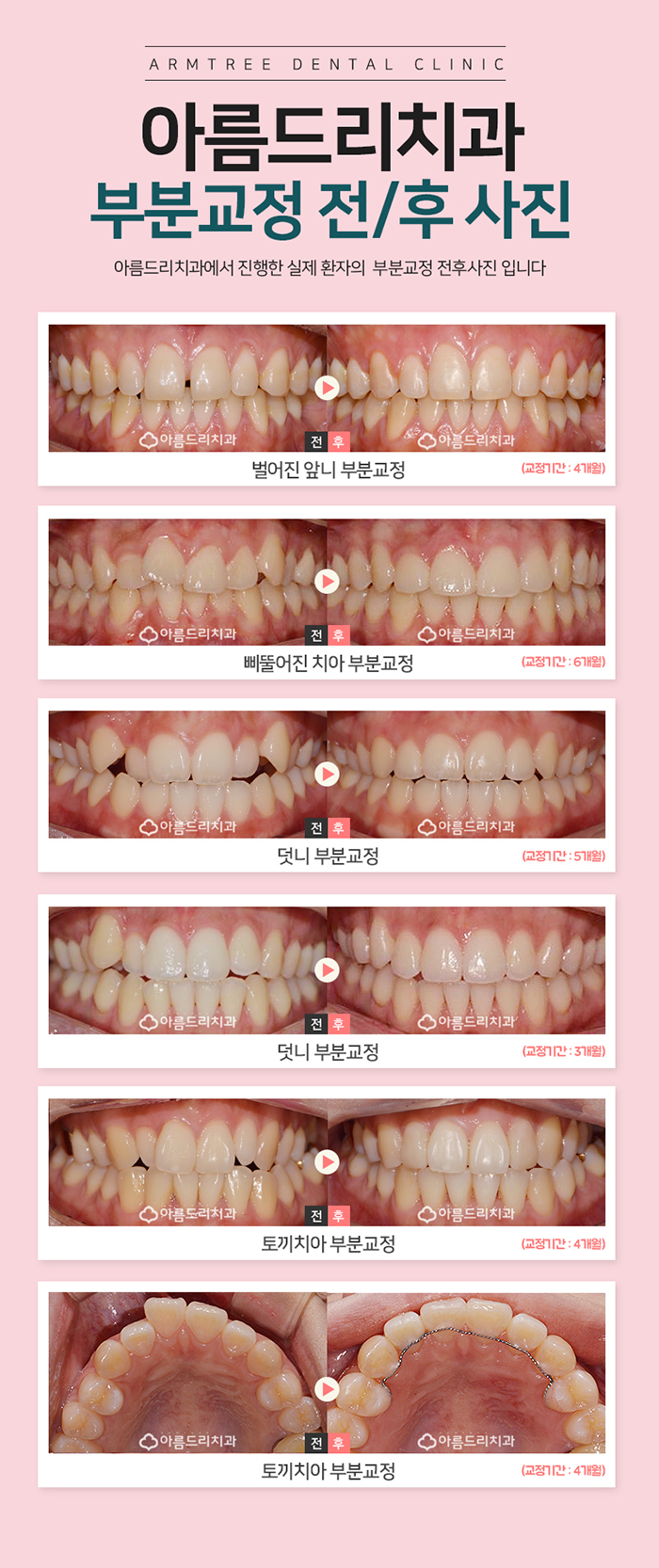 윗니교정 비용 알아볼까? 관련 이미지 5