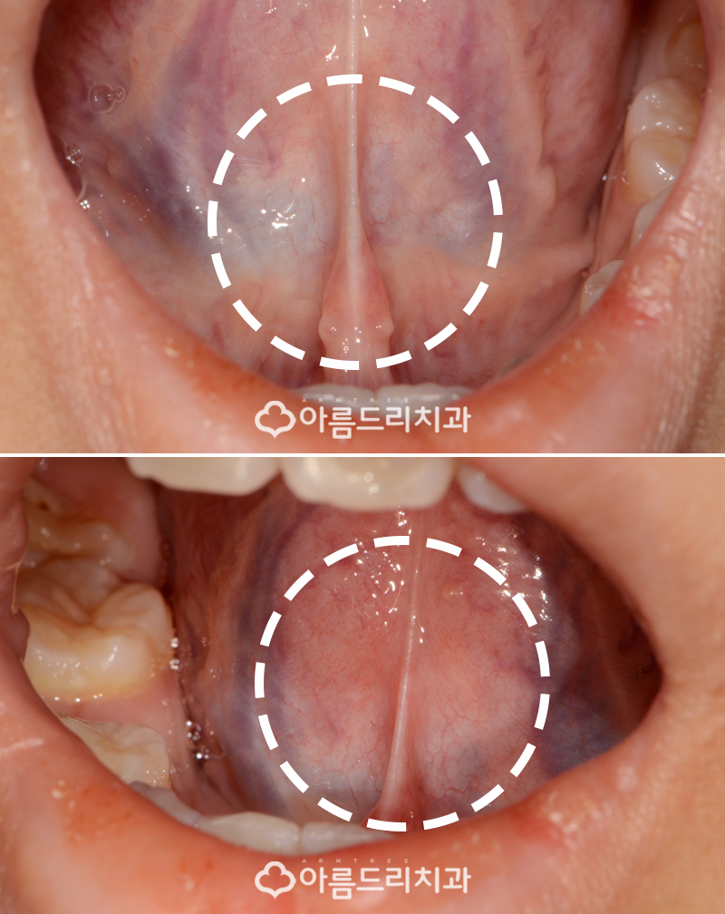 성인설소대수술 단축증 비용과 후기 관련 이미지 4