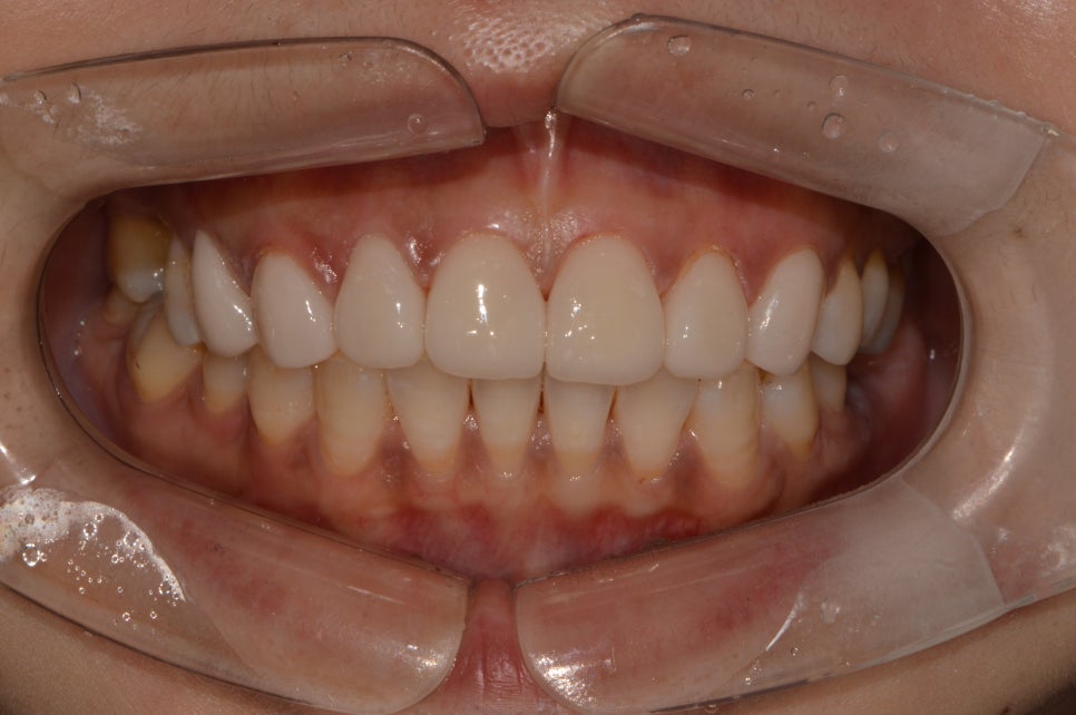 [신논현 치과] 3D 구강 스캐너_정확하게 본뜨기 관련 이미지 13