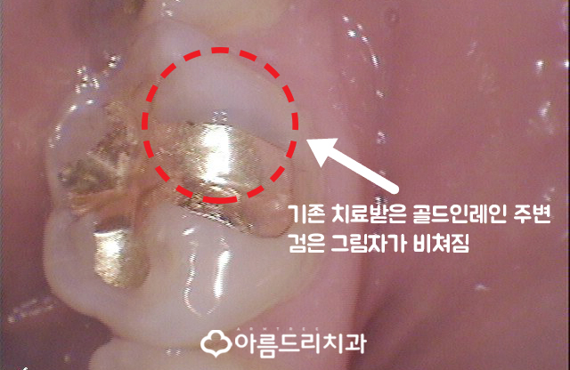 금니 2차충치 생기는 이유와 치료 관련 이미지 5