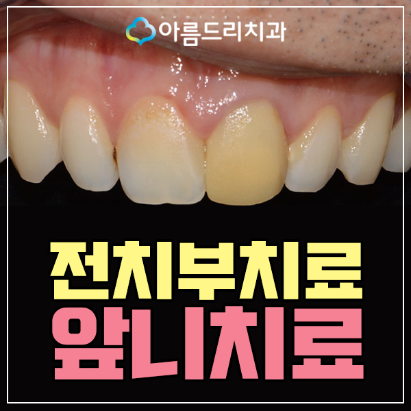 앞니 임시치아 전치부 크라운 재치료 관련 이미지 1