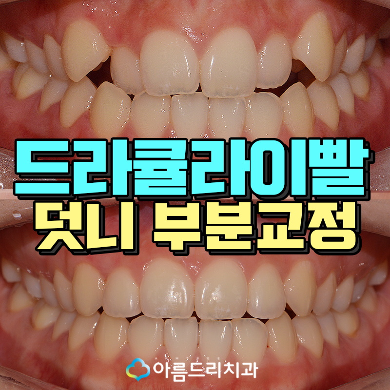 덧니부분교정 앞니 이런후기만 관련 이미지 1