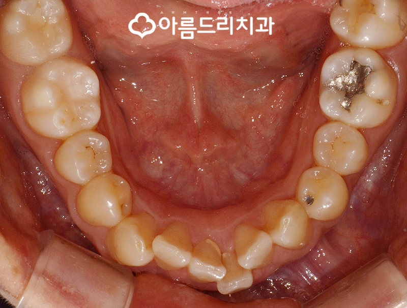 급속치아교정 코티코토미 피질골절단술 후기 관련 이미지 6