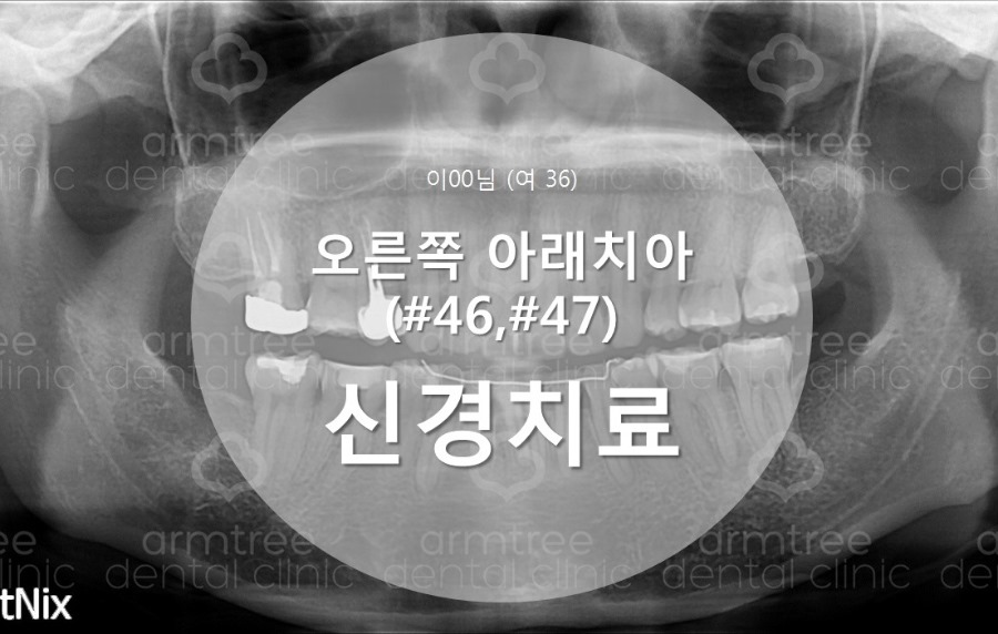 [치아 신경치료] #46,47번(오른쪽 아래 치아) 통증으로 내원 관련 이미지 1