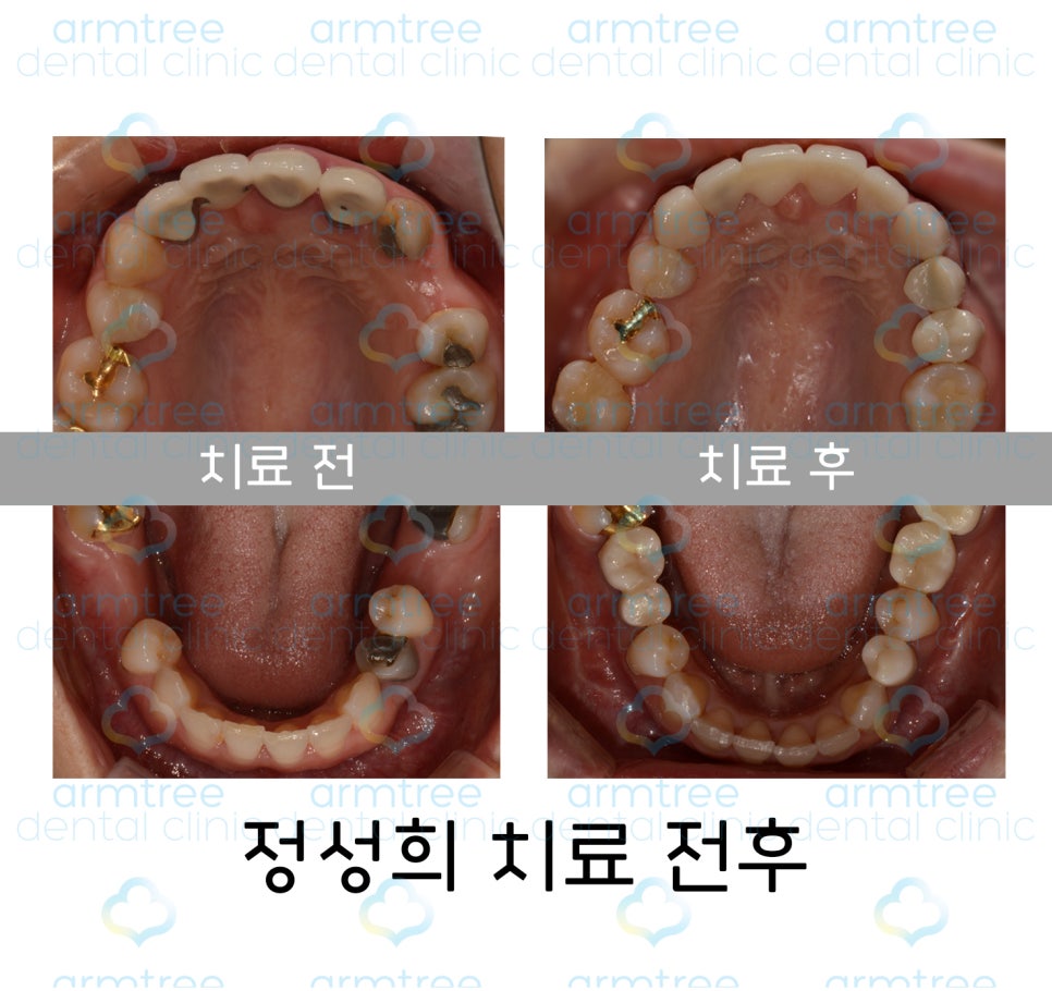 이현정 원장의 아름다운 당신 시즌 1 (8회 정성희 도전자) 임플란트, 신경치료, 치아성형, 올세라믹, 치아미백, 화이트랩스 관련 이미지 3