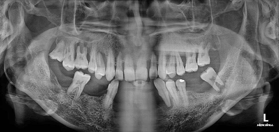 부분교정+임플란트(진료일기) 관련 이미지 1