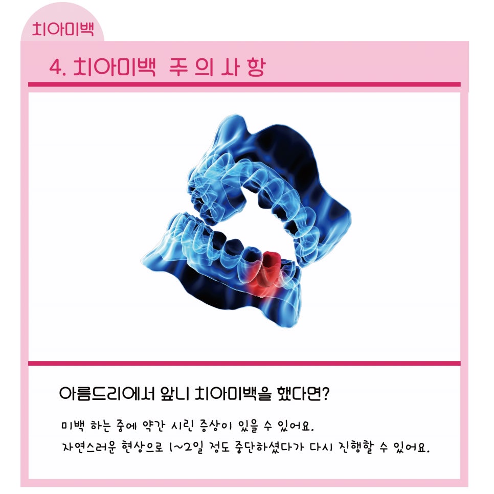신논현역치과_치아미백 주의사항_아름드리치과 관련 이미지 8