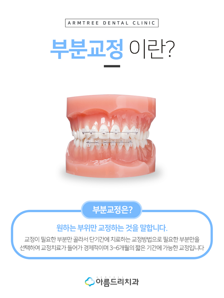 부분치아교정 틀어진앞니 후기역시 관련 이미지 4