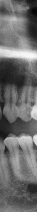 신논현역치과 사랑니 발치를 원한다면 관련 이미지 11