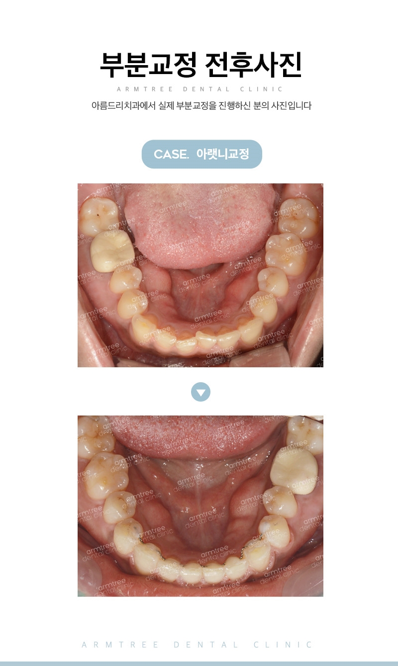 부분교정기간 부담제로 신논현역 아름드리치과 관련 이미지 14