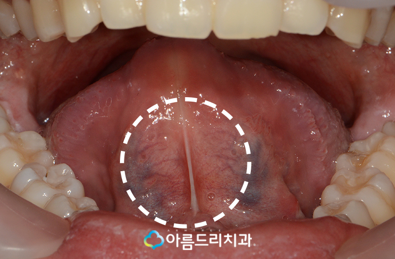 성인설소대수술 후기 단축증 해결 관련 이미지 4