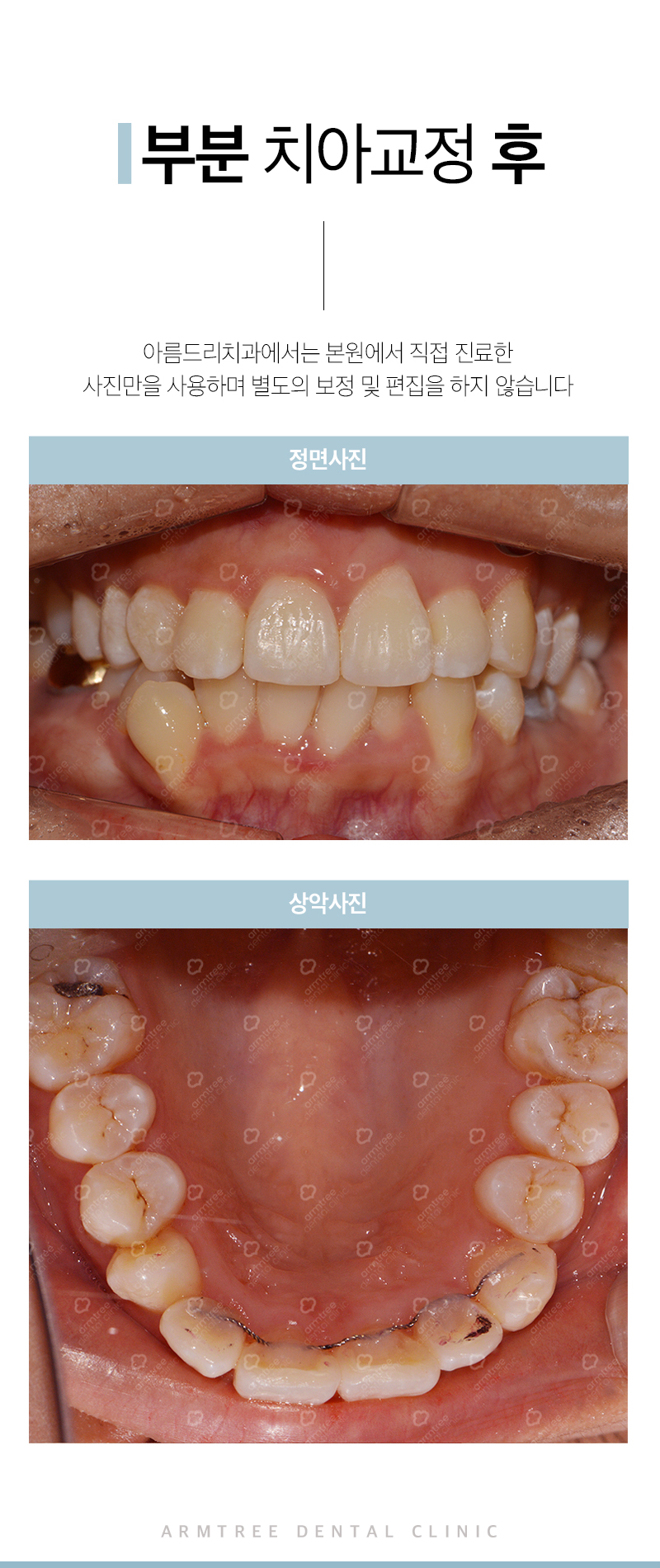 앞니부분교정 꼼꼼하고 예리하게 관련 이미지 11