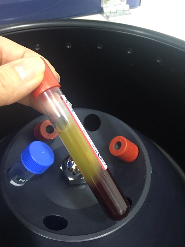 신논현역치과 PRF 자가혈 임플란트. 안전한 임플란트_아름드리 치과 관련 이미지 7