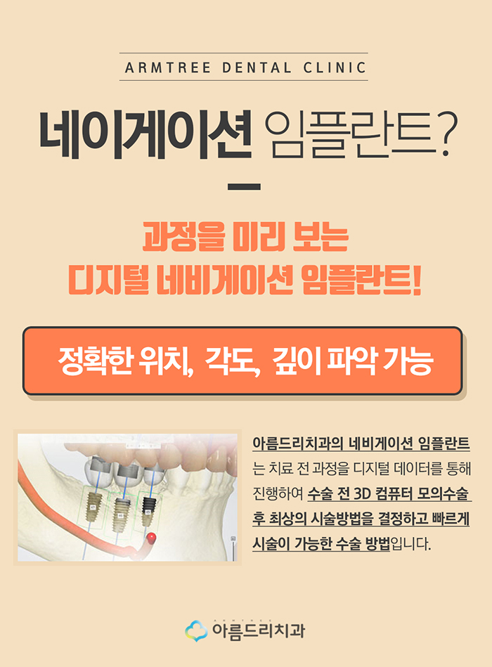 컴퓨터분석 임플란트 비용 아름드리 관련 이미지 4