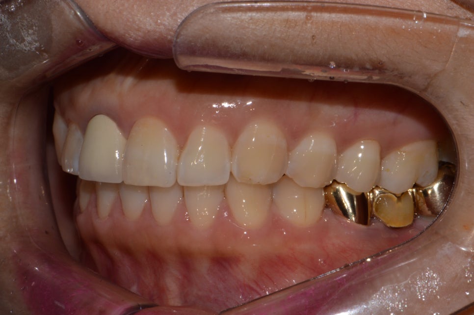 앞니 올세라믹 _재시술 (잇몸변색,메탈노출) 관련 이미지 3