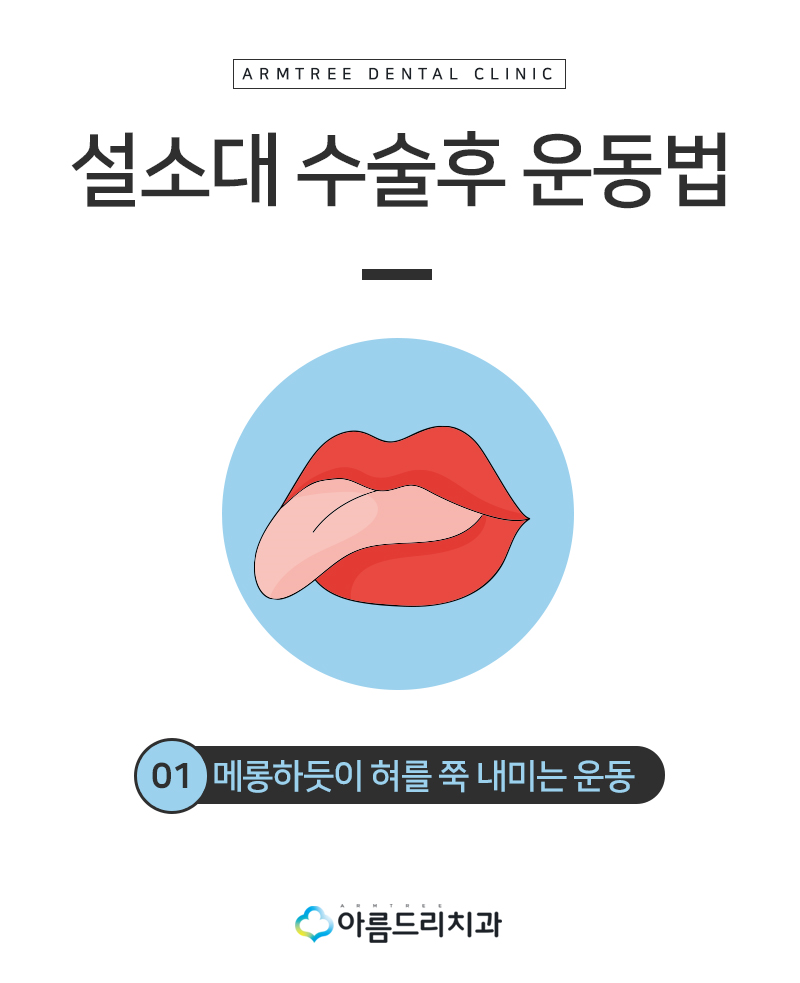 설소대수술 - 실제후기로 보는 확연한 차이 관련 이미지 10