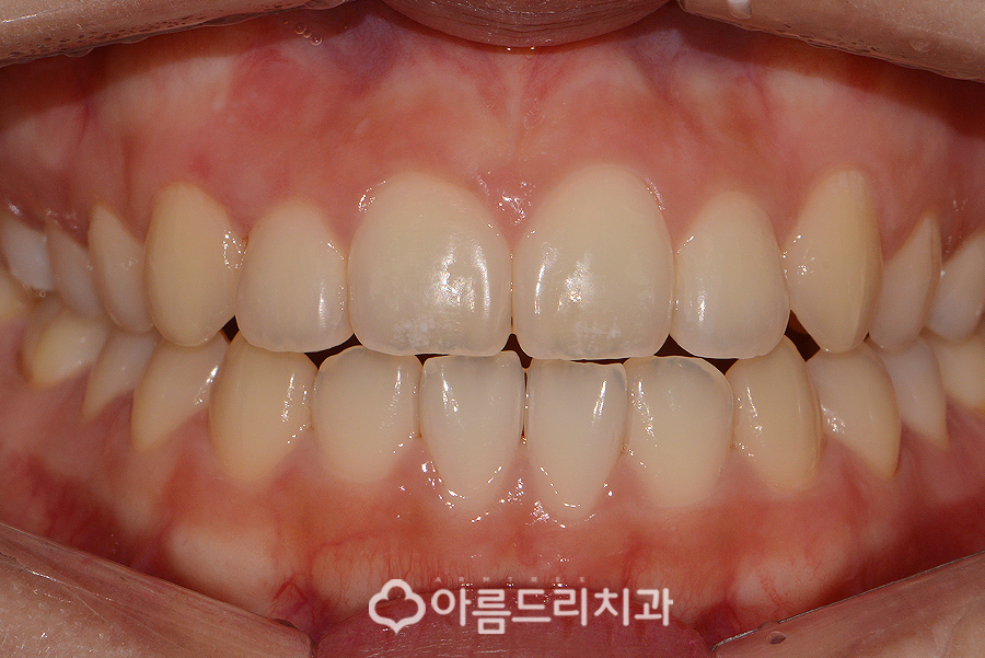 앞니부분교정기간 후기의 변화 관련 이미지 6