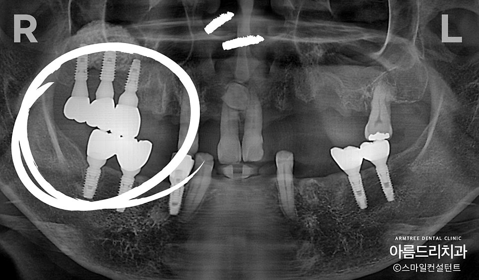 임플란트 심미보철 전후 아름드리치과 진료일기 관련 이미지 5