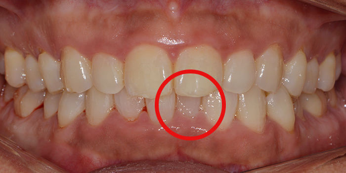 아랫니부분교정 가격 후기 정보후기 관련 이미지 3
