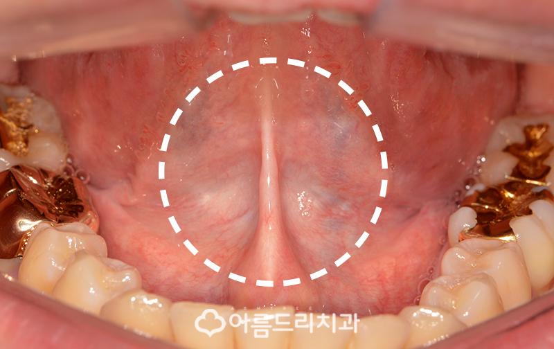 성인설소대수술 혀유착증 강남 바로알기 관련 이미지 3