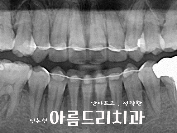 덧니 교정, 악궁 확장장치, 쁘띠 교정_신논현역 아름드리치과 관련 이미지 13