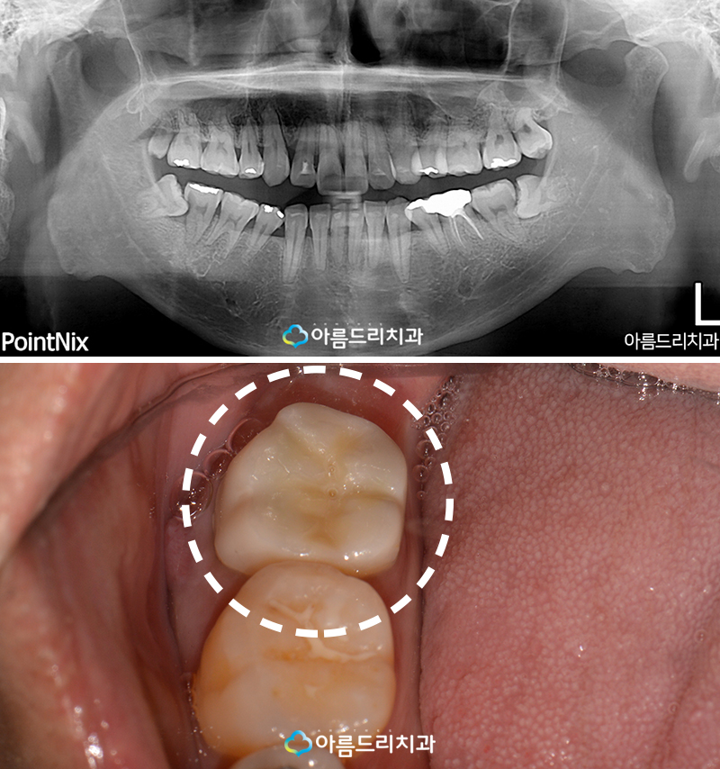치아재식술 후기 자연치아지키기 관련 이미지 3