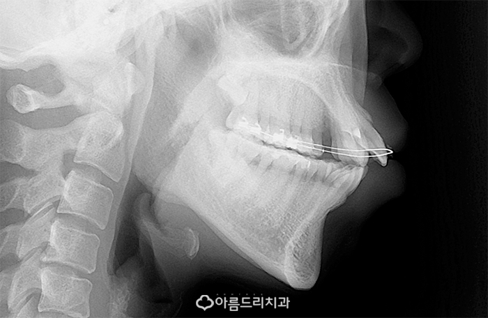 치아교정얼굴변화 어떠한가? 관련 이미지 3