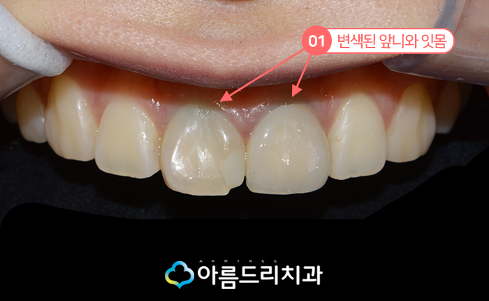 실활치미백 앞니 색깔 신경치료 치아변색 후기 관련 이미지 3