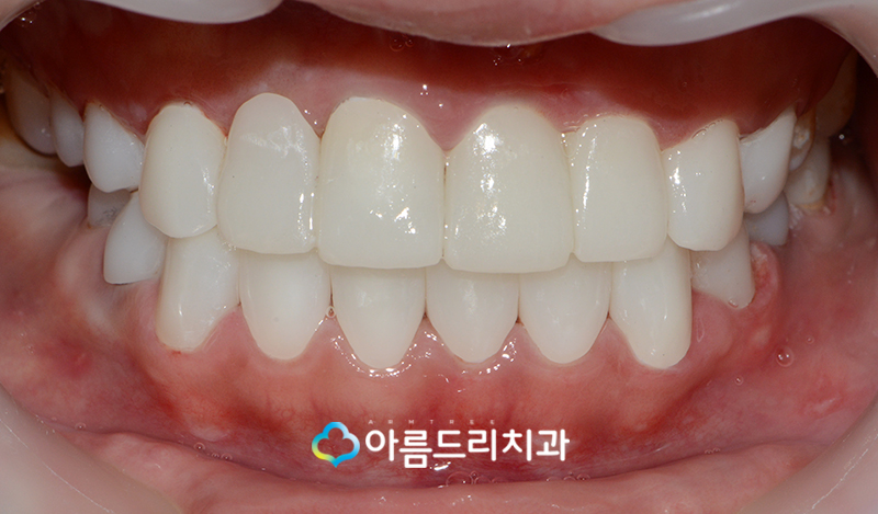 못생긴 앞니 치아라미네이트로 빠르게 관련 이미지 8