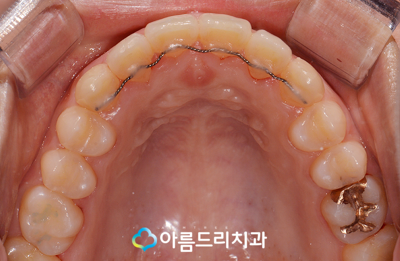 덧니부분교정 앞니 이런후기만 관련 이미지 11