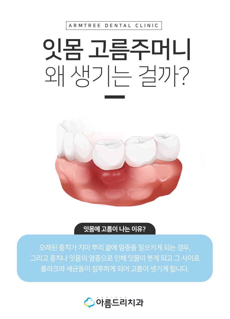 잇몸고름주머니 잇몸에고름 치아재식술 치료 관련 이미지 5