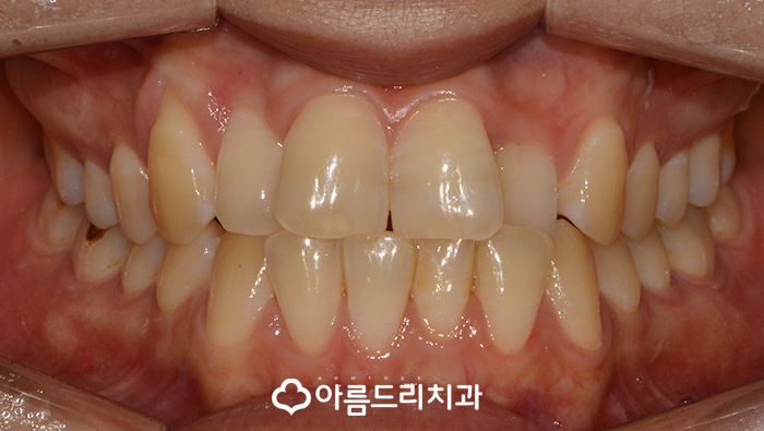 앞니돌출 앞니돌출교정 치과 아름드리 관련 이미지 2