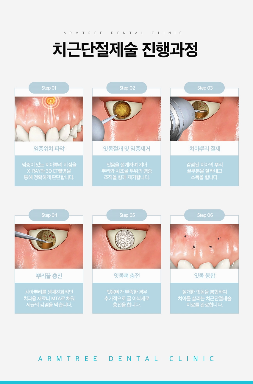 치근단절제술 염증 신뢰있는 후기 아름드리치과 관련 이미지 5