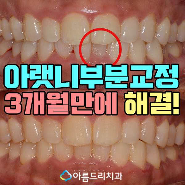 아랫니부분교정 가격 후기 정보후기 관련 이미지 1