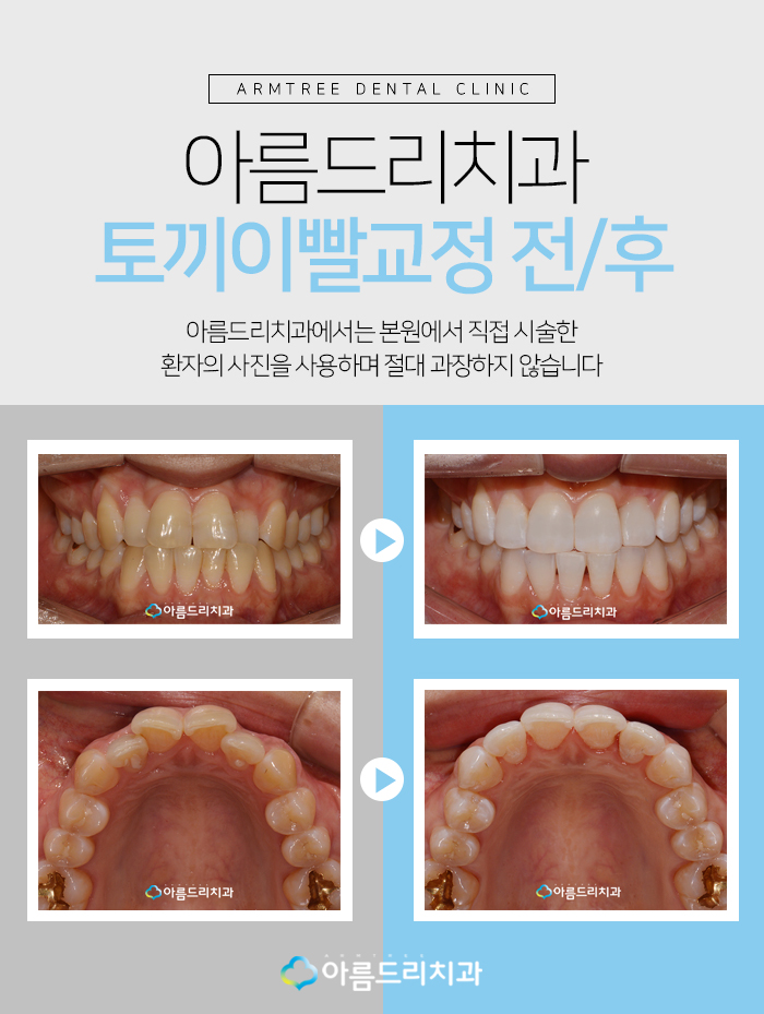 토끼이빨교정 앞니문제 해결 관련 이미지 9
