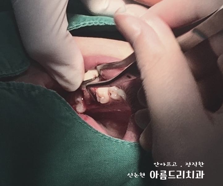 치아재식_임플란트 안 하고 치아 살릴 순 없나요?(신논현역 치과) 관련 이미지 21