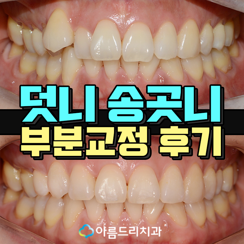 드라큘라이빨 송곳니교정 부분교정후기 관련 이미지 1