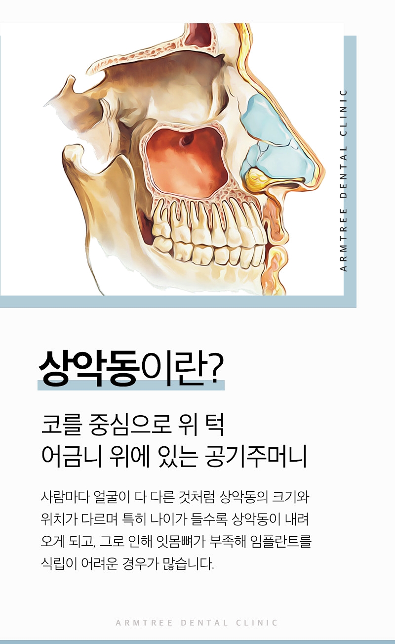 상악동거상술 부작용없는 아름드리치과 관련 이미지 3