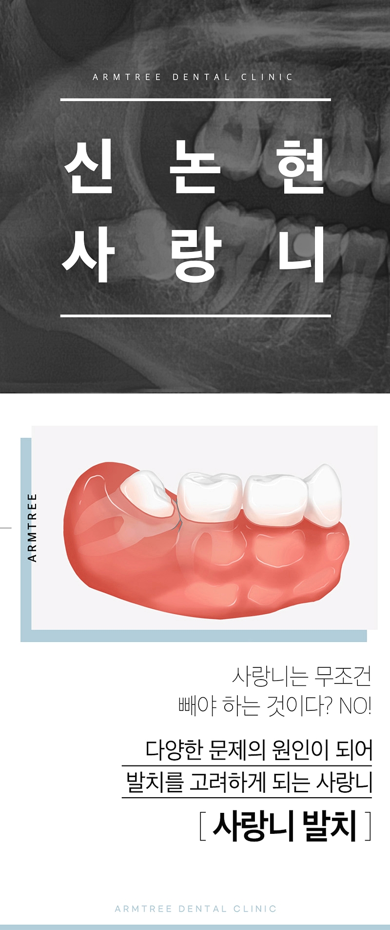 신논현치과 사랑니발치 치과는 신중하게 관련 이미지 1