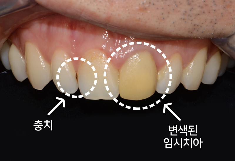 앞니 임시치아 전치부 크라운 재치료 관련 이미지 5