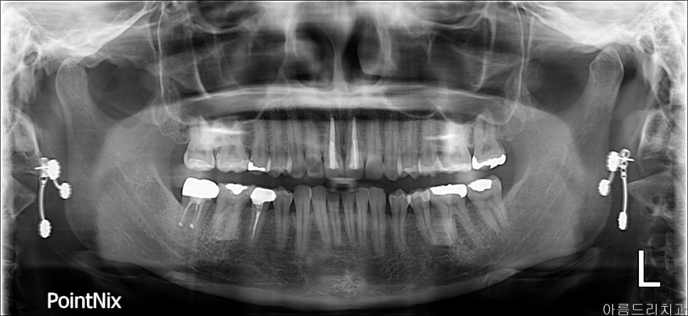 [신논현 치과] 임플란트 대신 치아재식(아름드리치과) 관련 이미지 1